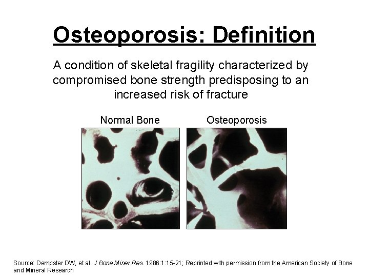 Osteoporosis: Definition A condition of skeletal fragility characterized by compromised bone strength predisposing to