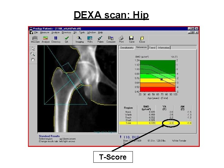 DEXA scan: Hip T-Score 