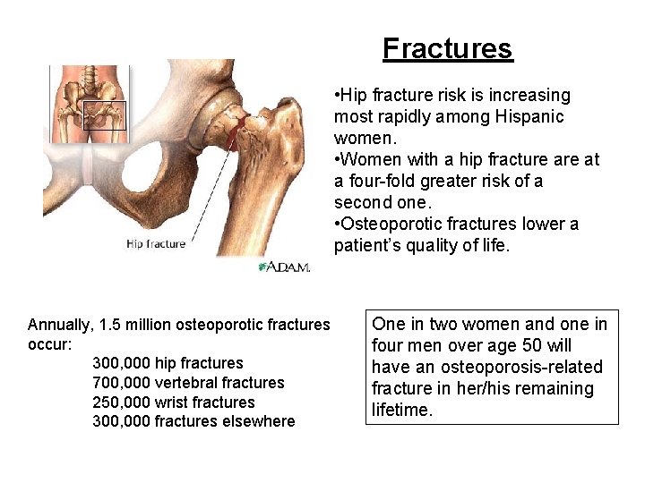 Fractures • Hip fracture risk is increasing most rapidly among Hispanic women. • Women