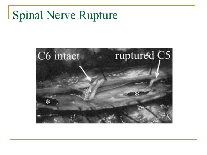 Spinal Nerve Rupture 
