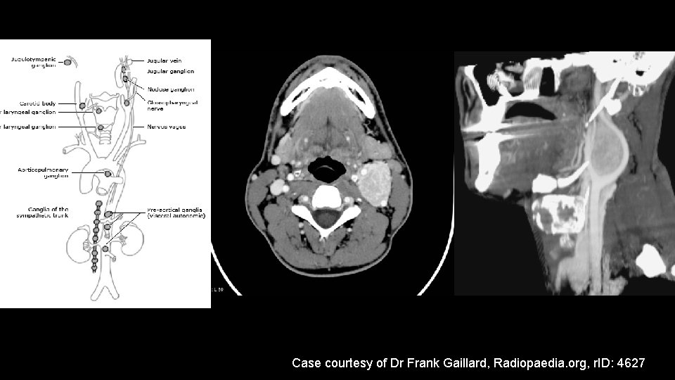 Case courtesy of Dr Frank Gaillard, Radiopaedia. org, r. ID: 4627 Case courtesy of Dr Frank Gaillard, Radiopaedia. org, r. ID: 4627