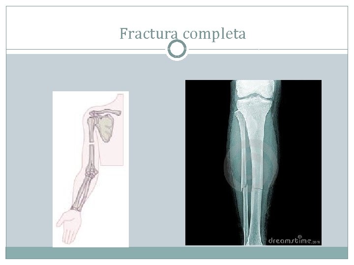 gradul de artroză a semnelor radiologice ale genunchiului medicamente pentru bursita articulației șoldului