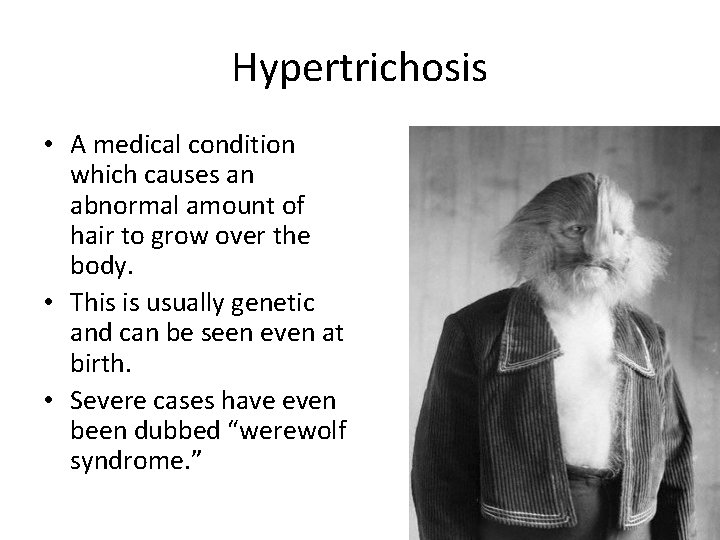 Hypertrichosis • A medical condition which causes an abnormal amount of hair to grow