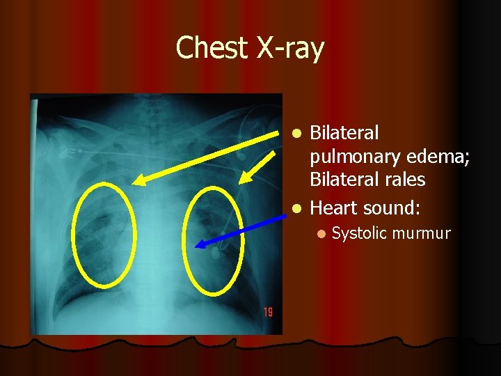 Chest X-ray Bilateral pulmonary edema; Bilateral rales l Heart sound: l l Systolic murmur