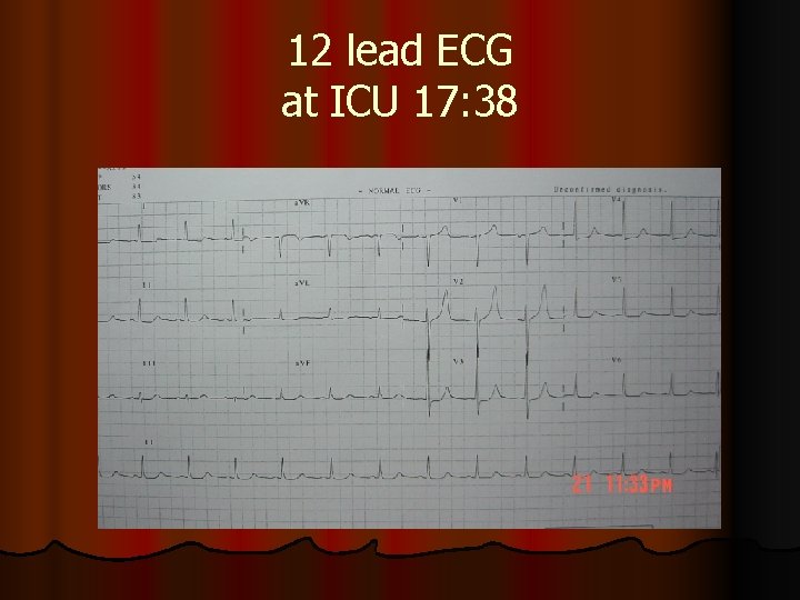 12 lead ECG at ICU 17: 38 