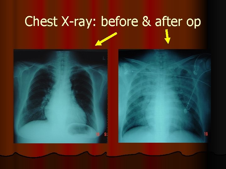 Chest X-ray: before & after op 