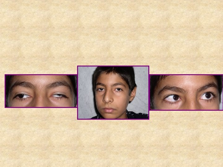 Syndrome wandering eye Nystagmus