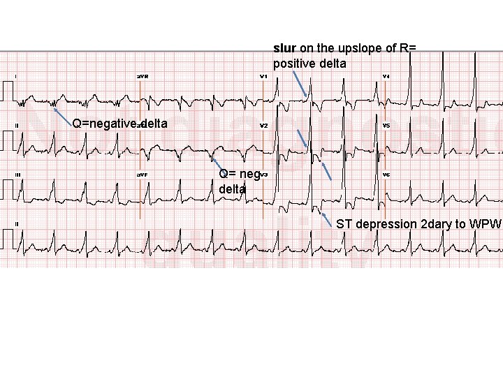 slur on the upslope of R= positive delta Q=negative delta Q= neg delta ST