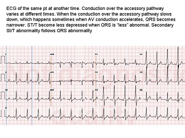 ECG of the same pt at another time. Conduction over the accessory pathway varies