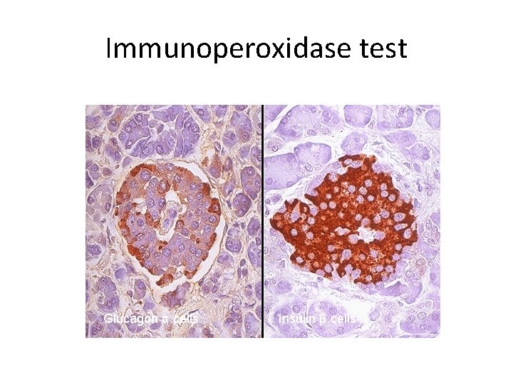 Immunoperoxidase test Glucagon α cells Insulin β cells 