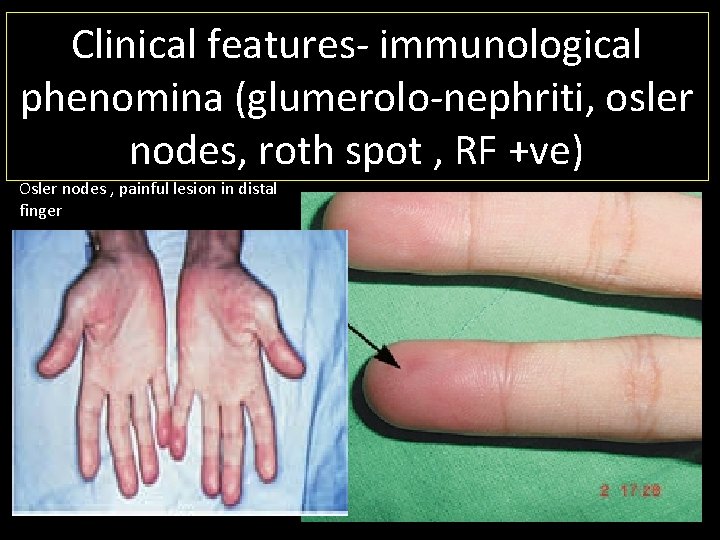 Clinical features- immunological phenomina (glumerolo-nephriti, osler nodes, roth spot , RF +ve) Osler nodes