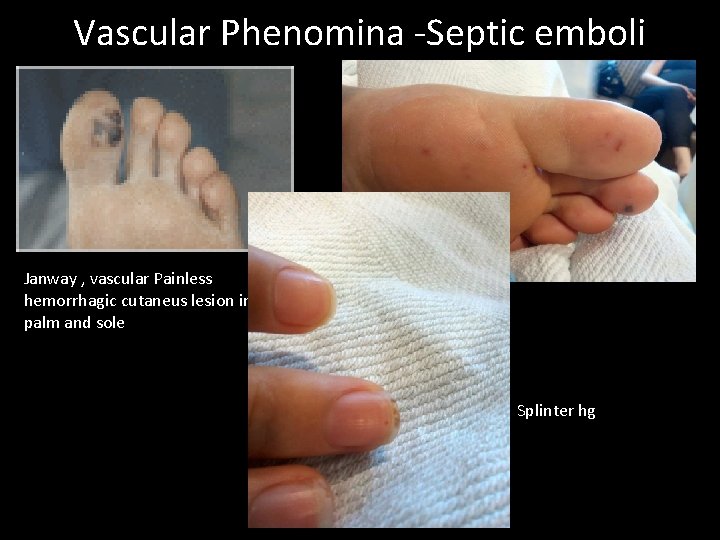 Vascular Phenomina -Septic emboli Janway , vascular Painless hemorrhagic cutaneus lesion in the palm