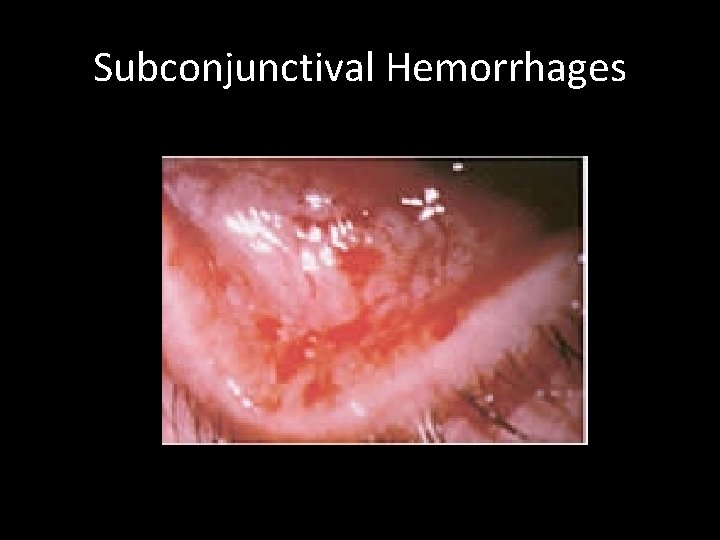 Subconjunctival Hemorrhages 