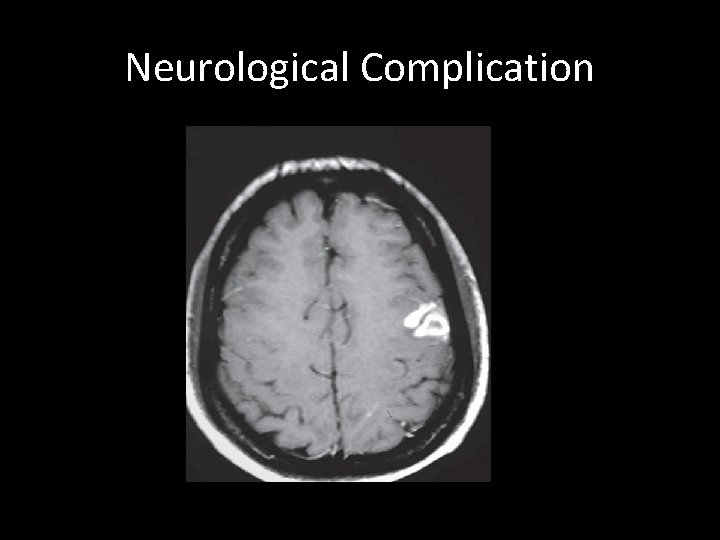 Neurological Complication 