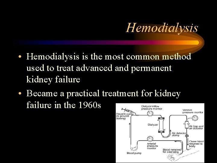 Hemodialysis • Hemodialysis is the most common method used to treat advanced and permanent