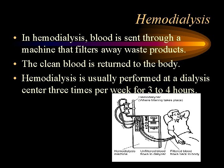 Hemodialysis • In hemodialysis, blood is sent through a machine that filters away waste