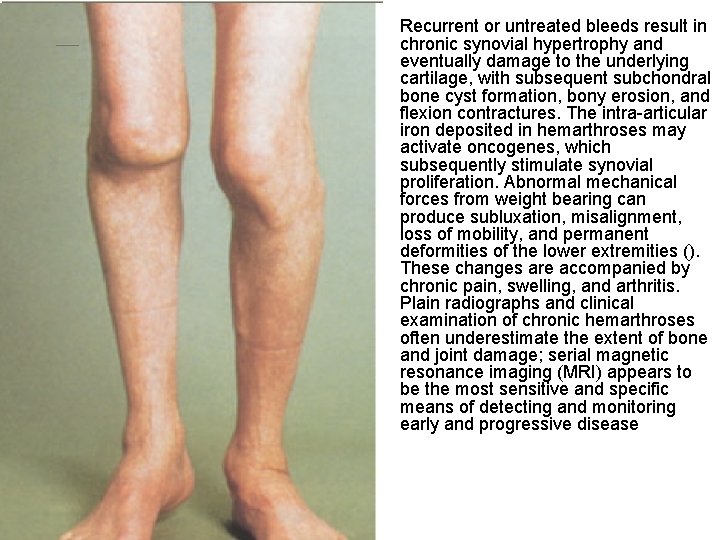  • Recurrent or untreated bleeds result in chronic synovial hypertrophy and eventually damage