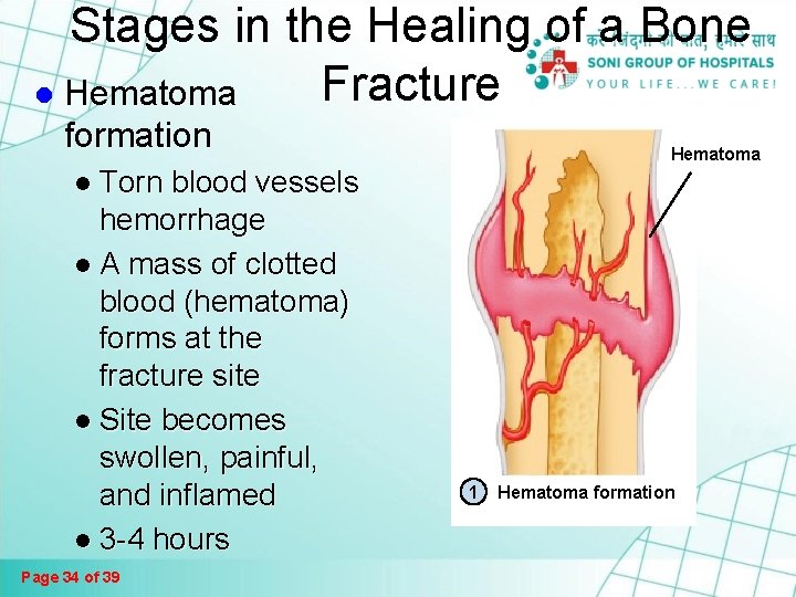 Fractures And Bone Healing Page 1 Of 39