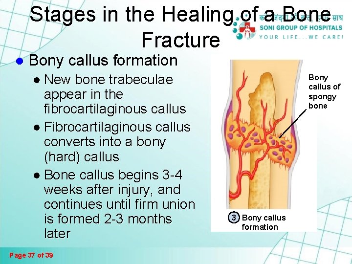 Fractures And Bone Healing Page 1 Of 39