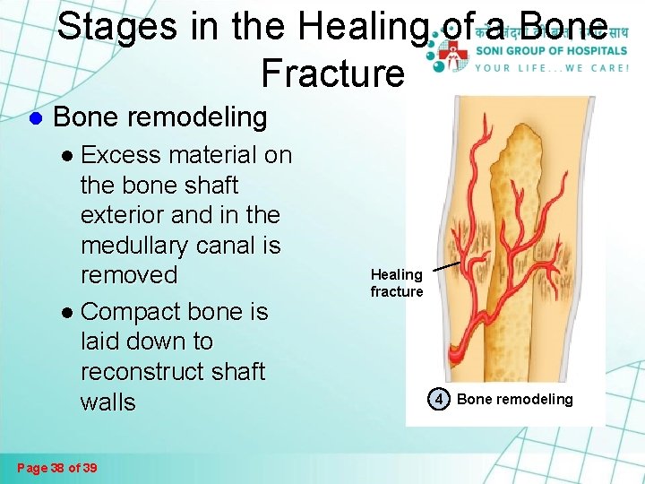 Fractures And Bone Healing Page 1 Of 39