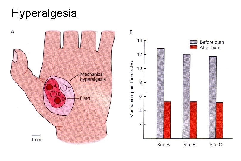 Hyperalgesia 