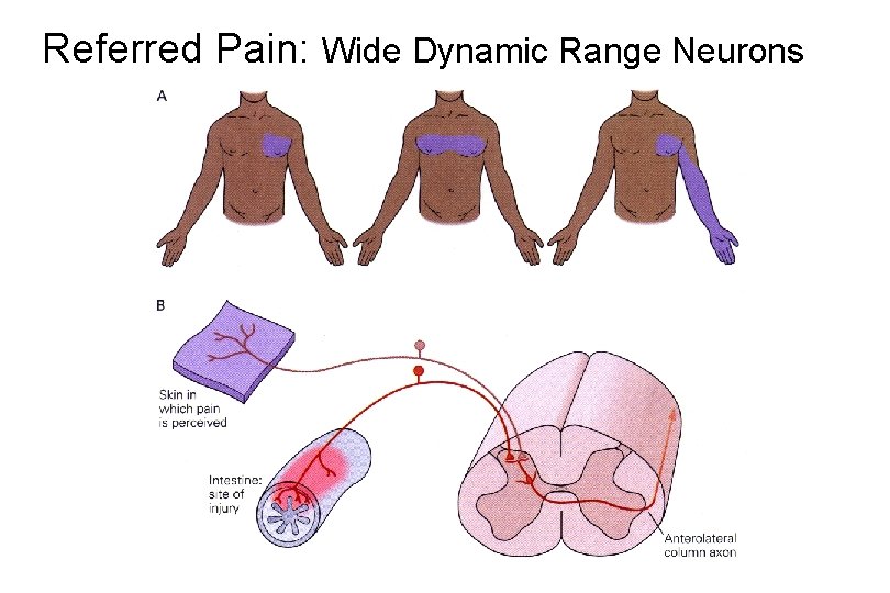 Referred Pain: Wide Dynamic Range Neurons 