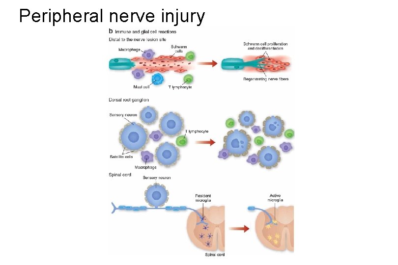 Peripheral nerve injury 