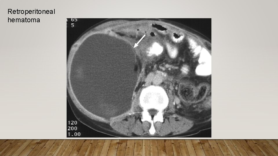 Retroperitoneal hematoma 