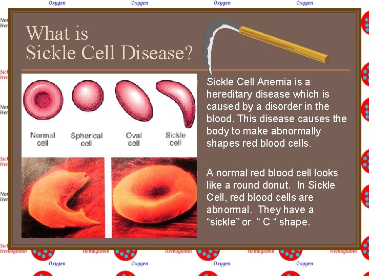 What is Sickle Cell Disease? n Sickle Cell Anemia is a hereditary disease which