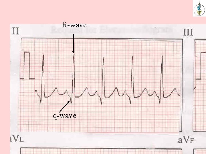 R-wave q-wave 