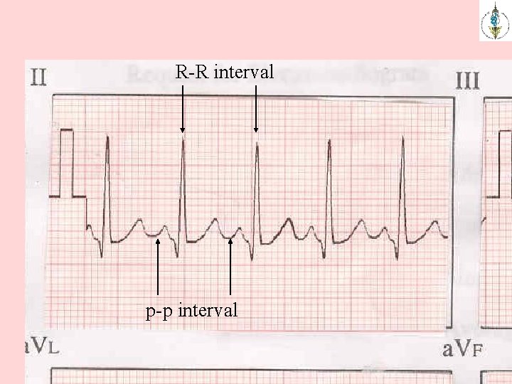 R-R interval p-p interval 