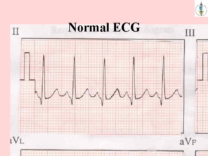 Normal ECG 
