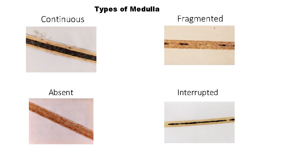 Continuous Absent Types of Medulla Fragmented Interrupted 