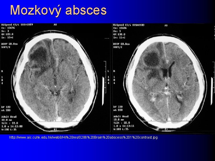 Mozkový absces http: //www. aic. cuhk. edu. hk/web 8/Hi%20 res/0286%20 Brain%20 abscess%201%20 contrast. jpg