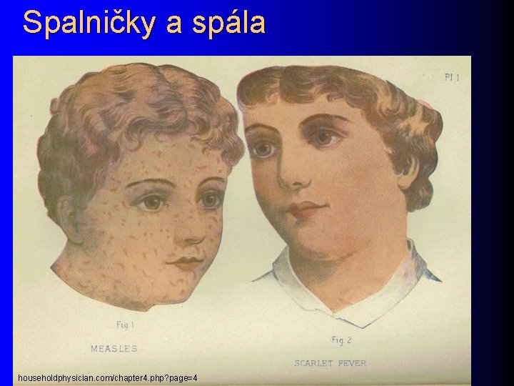 Spalničky a spála householdphysician. com/chapter 4. php? page=4 