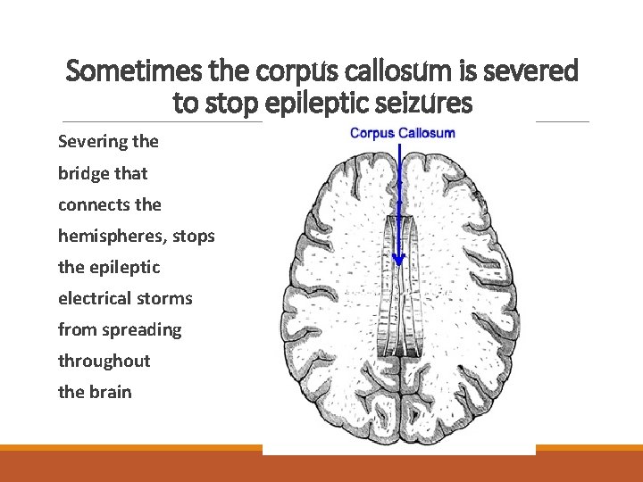 Sometimes the corpus callosum is severed to stop epileptic seizures Severing the bridge that