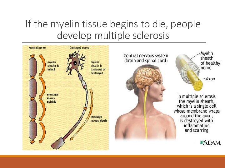 If the myelin tissue begins to die, people develop multiple sclerosis 