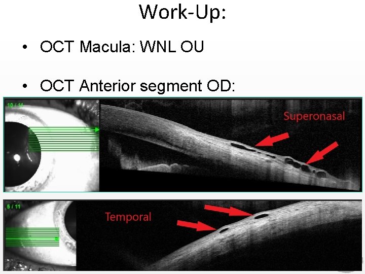 Work-Up: • OCT Macula: WNL OU • OCT Anterior segment OD: Work-Up: • OCT Macula: WNL OU • OCT Anterior segment OD: