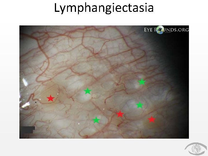 Lymphangiectasia Lymphangiectasia