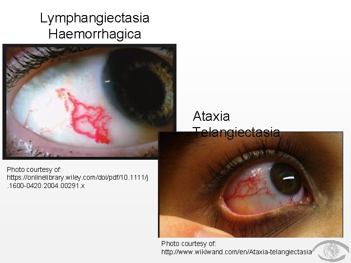 Lymphangiectasia Haemorrhagica Ataxia Telangiectasia Photo courtesy of: https: //onlinelibrary. wiley. com/doi/pdf/10. 1111/j. 1600 -0420. Lymphangiectasia Haemorrhagica Ataxia Telangiectasia Photo courtesy of: https: //onlinelibrary. wiley. com/doi/pdf/10. 1111/j. 1600 -0420.