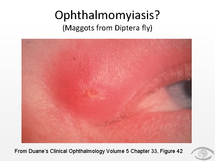Ophthalmomyiasis? (Maggots from Diptera fly) From Duane’s Clinical Ophthalmology Volume 5 Chapter 33, Figure Ophthalmomyiasis? (Maggots from Diptera fly) From Duane’s Clinical Ophthalmology Volume 5 Chapter 33, Figure