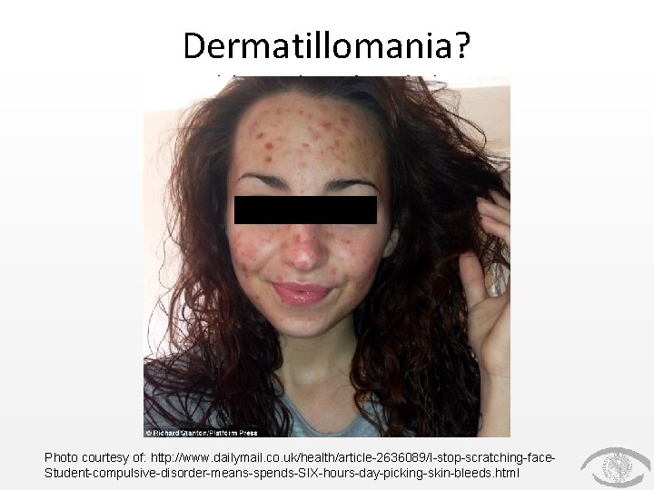 Dermatillomania? (skin picking disorder) Photo courtesy of: http: //www. dailymail. co. uk/health/article-2636089/I-stop-scratching-face. Student-compulsive-disorder-means-spends-SIX-hours-day-picking-skin-bleeds. html Dermatillomania? (skin picking disorder) Photo courtesy of: http: //www. dailymail. co. uk/health/article-2636089/I-stop-scratching-face. Student-compulsive-disorder-means-spends-SIX-hours-day-picking-skin-bleeds. html