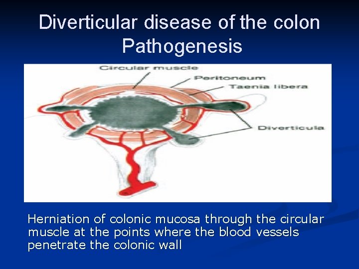 Diverticular disease of the colon Pathogenesis Herniation of colonic mucosa through the circular muscle