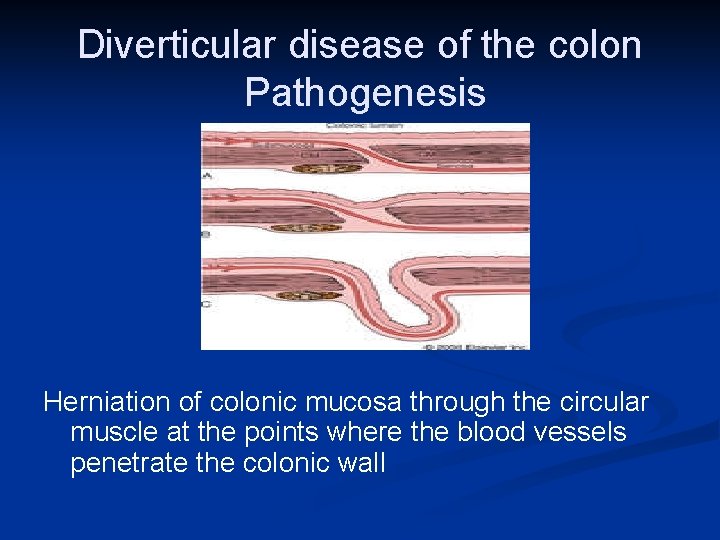 Diverticular disease of the colon Pathogenesis Herniation of colonic mucosa through the circular muscle