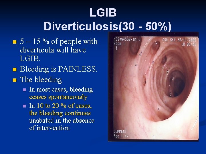 LGIB Diverticulosis(30 - 50%) n n n 5 – 15 % of people with