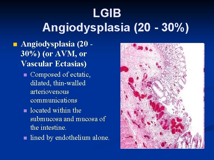 LGIB Angiodysplasia (20 - 30%) n Angiodysplasia (20 30%) (or AVM, or Vascular Ectasias)