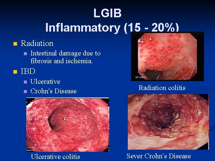 LGIB Inflammatory (15 - 20%) n Radiation n n Intestinal damage due to fibrosis