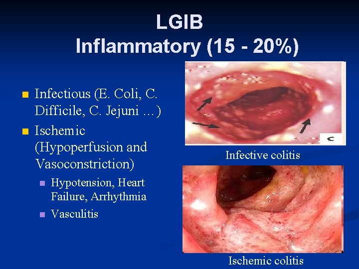 LGIB Inflammatory (15 - 20%) n n Infectious (E. Coli, C. Difficile, C. Jejuni
