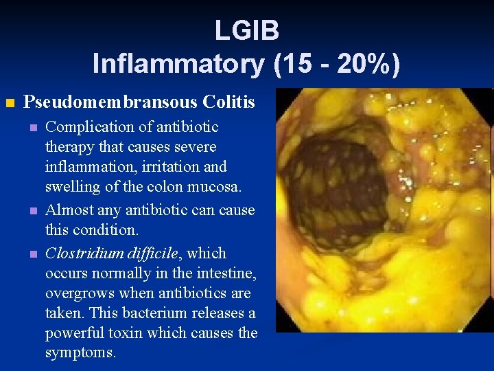LGIB Inflammatory (15 - 20%) n Pseudomembransous Colitis n n n Complication of antibiotic