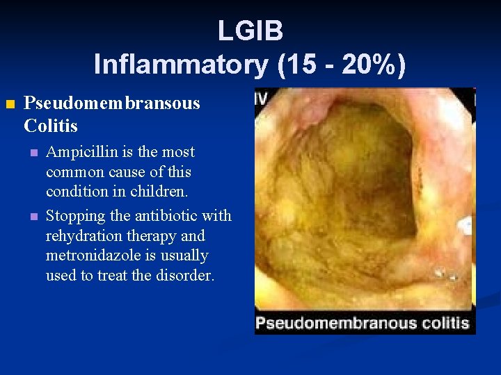 LGIB Inflammatory (15 - 20%) n Pseudomembransous Colitis n n Ampicillin is the most